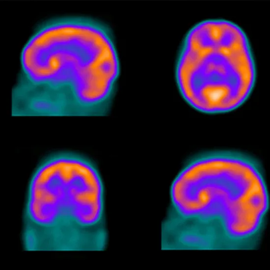 brain perfusion (spect) scan test